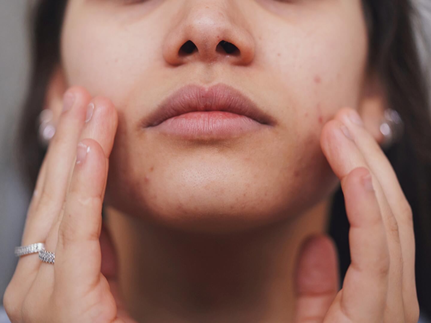 Nahaufnahme eines Gesichts einer Frau mit vielen roten Stellen und Pickeln, die Frau hält beide Hände an ihr Gesicht.